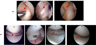 Potential causal role of synovial complement system activation in the development of post-traumatic osteoarthritis after anterior cruciate ligament injury or meniscus tear